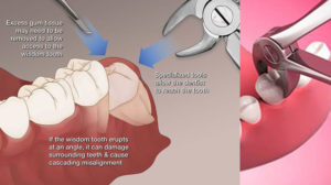 Dental Extraction Procedures