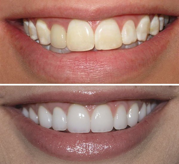 Top Five Factors to Consider Before Going for Teeth Whitening Nairobi